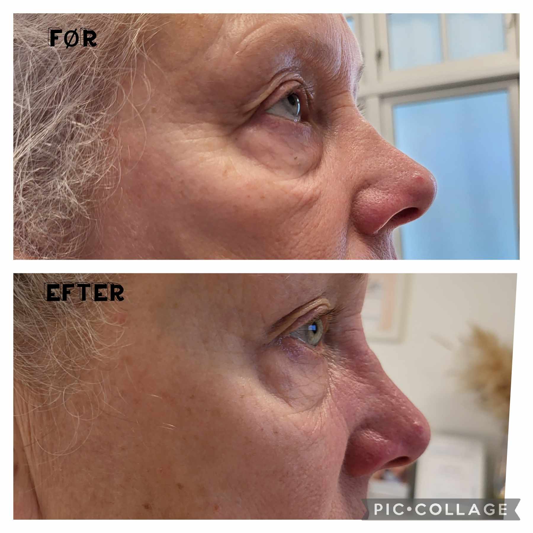 Før og efter Green PEEL® – billede 2