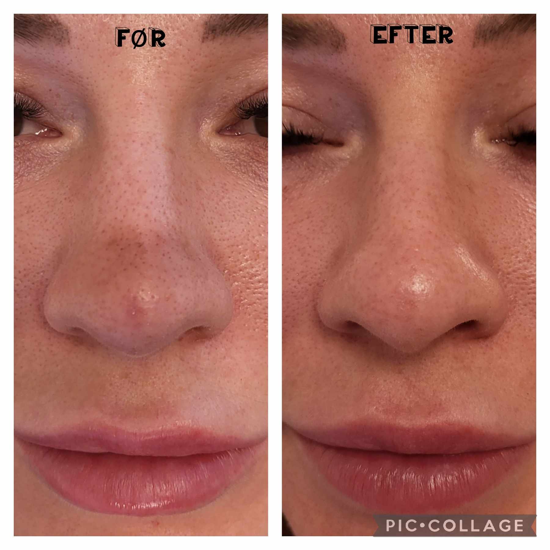 Før og efter Green PEEL® – billede 1