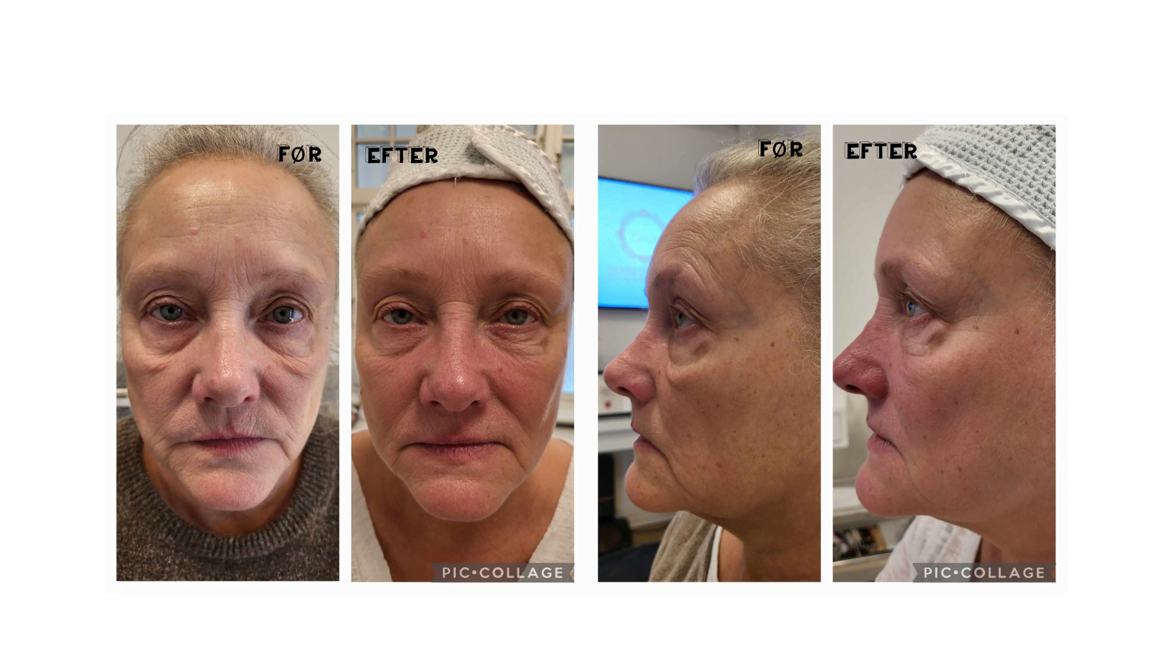 Før og efter Neostrata