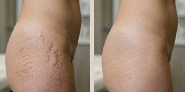 Strækmærkebehandling med PRP og PRF i Vanløse København