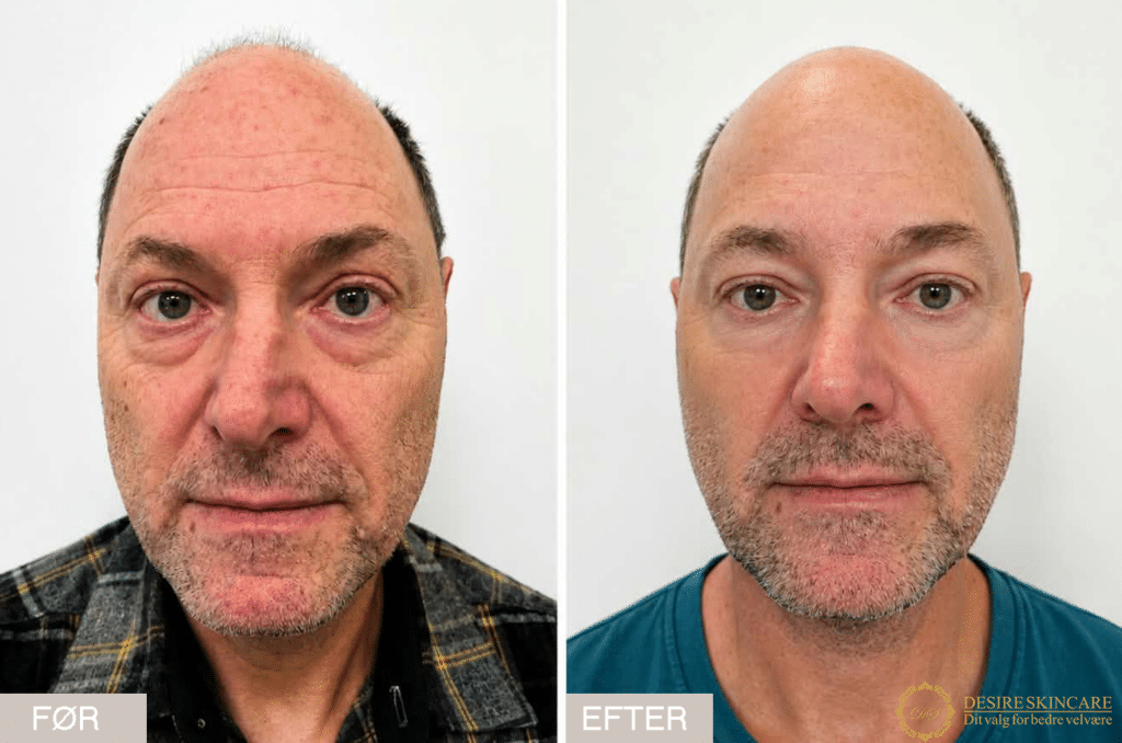 Resultat efter profhilo structura behandling hos Desire Skincare