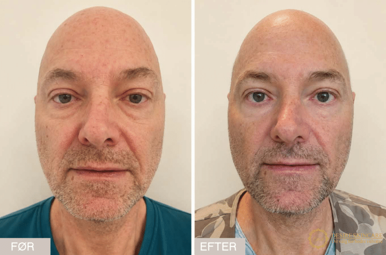 Profhilo behandling før og efter hos Desire Skincare