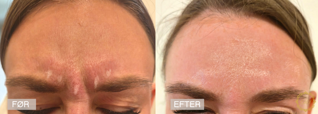 DesireSkincare_Rynkebehandling_Botox_Glabella 7 dage_FørEfter2