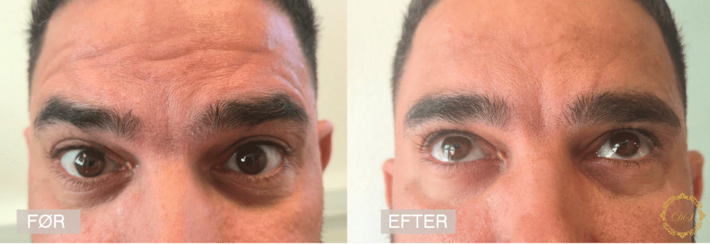 DesireSkincare_Rynkebehandling_Botox_Glabella og Panden 1 måned uger_FørEfter4